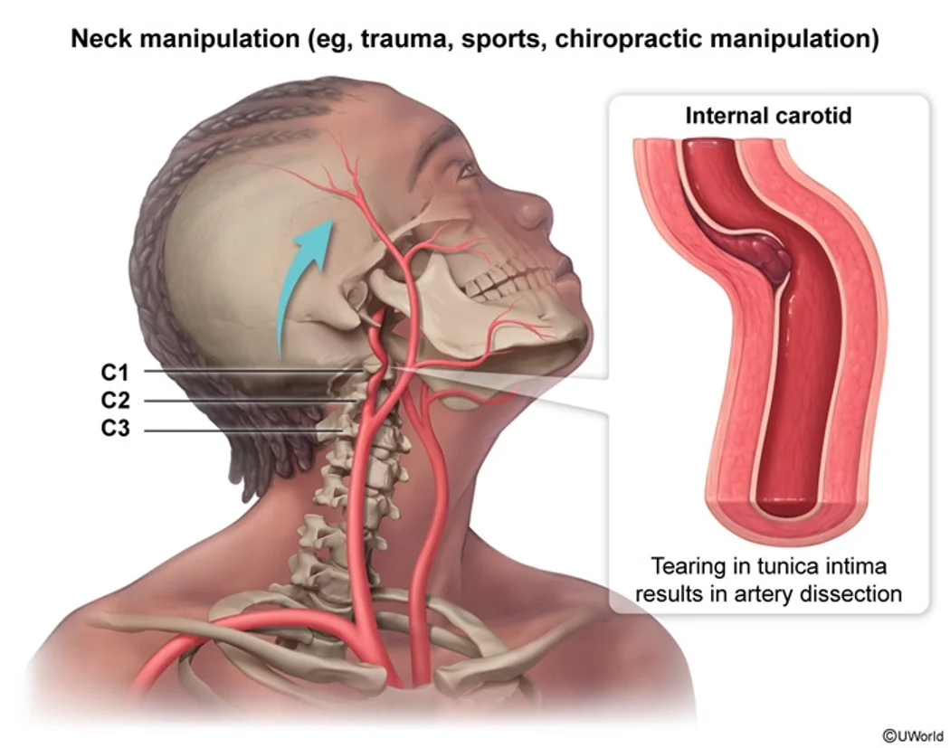 Carotid dissection from neck manipulation (trauma, sports, chiropractic manipulation): stretching the internal carotid over the upper cervical vertebrae tears the tunica intima.
