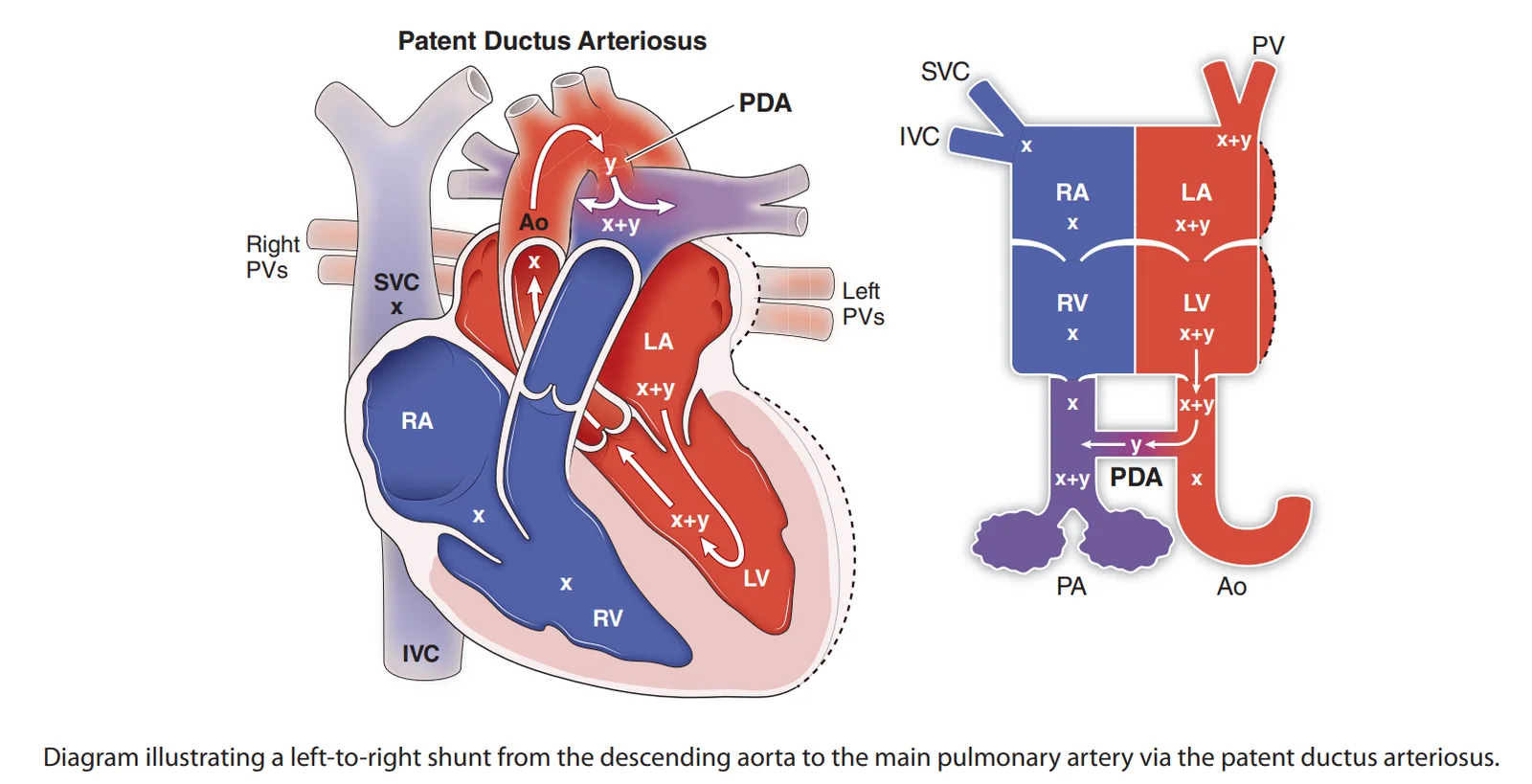 Patent ductus arteriosus: a left-to-right shunt from the descending aorta into the main pulmonary artery, so the lungs, left atrium and left ventricle receive extra flow.