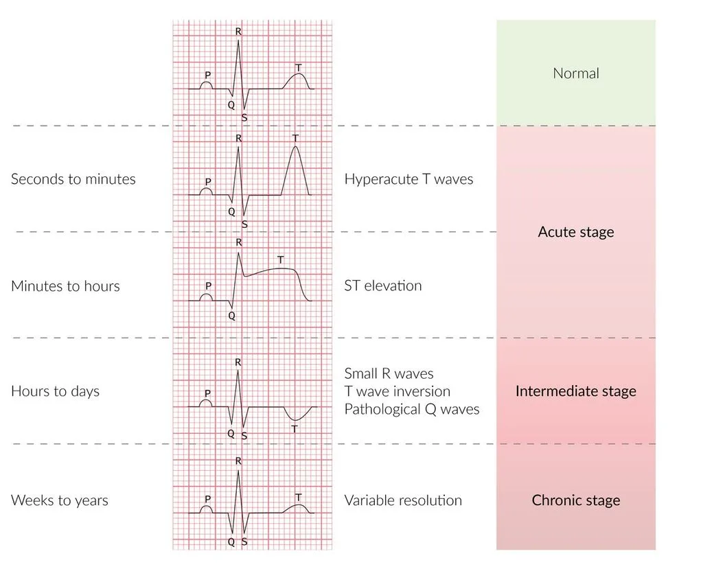 Timeline of ECG changes in STEMI. Seconds to minutes: hyperacute T waves. Minutes to hours: ST elevation. Hours to days: small R waves, T-wave inversion and pathological Q waves. Weeks to years: variable resolution, with Q waves often persisting.