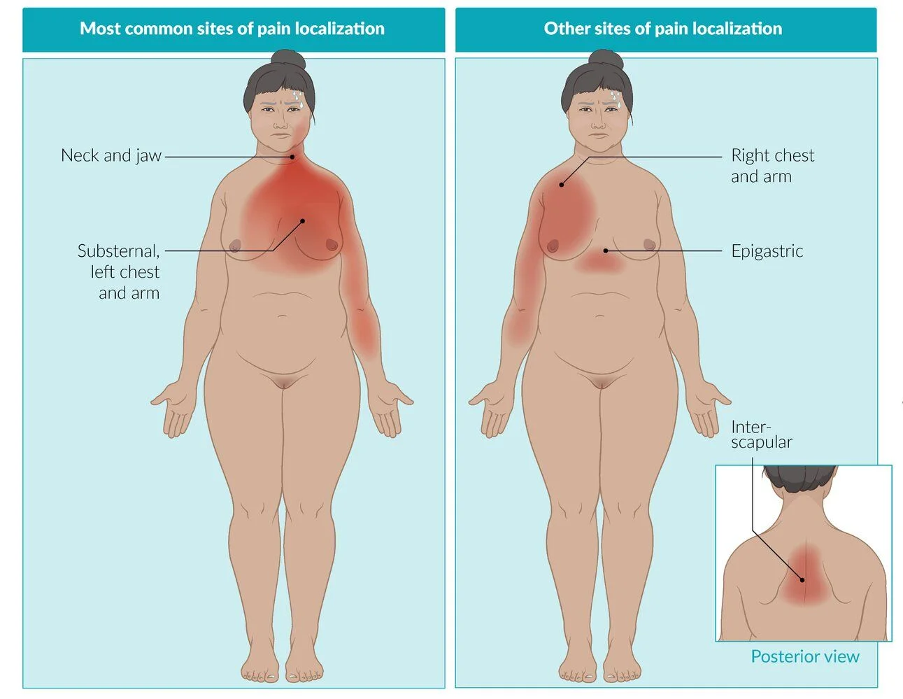 Where ischemic chest pain is felt. Most common (left): substernal, left chest and arm, neck and jaw. Other sites (right): right chest and arm, epigastrium, and between the shoulder blades on the back.