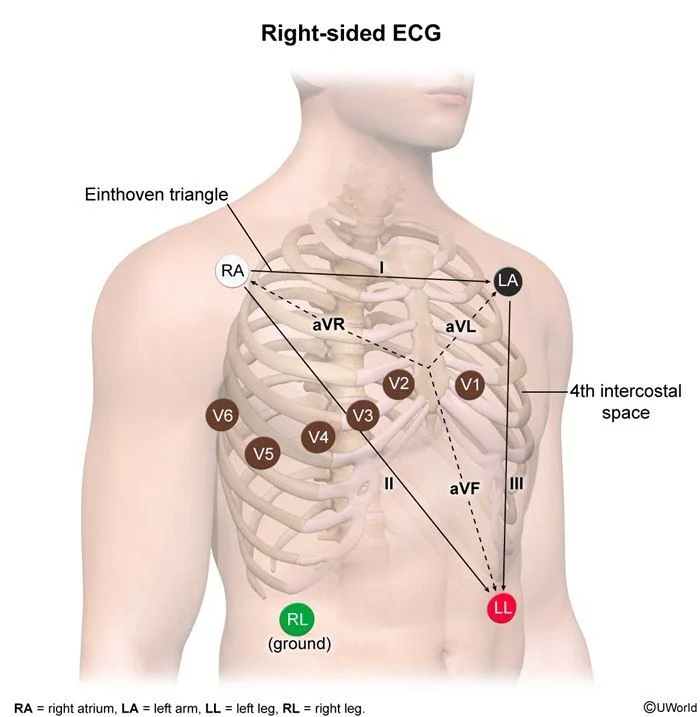 Right-sided ECG: the precordial leads are placed in a mirror image across the right chest (V4R at the right fifth intercostal space in the midclavicular line). ST elevation in V4R is highly accurate for right ventricular infarction.
