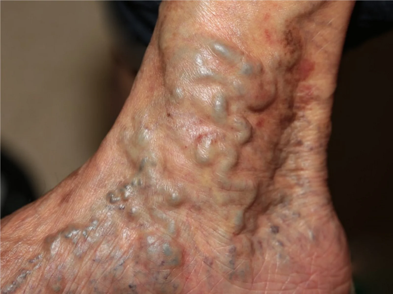 Varicose veins: dilated, tortuous, bulging superficial veins around the ankle, with brown pigmentation of the surrounding skin.
