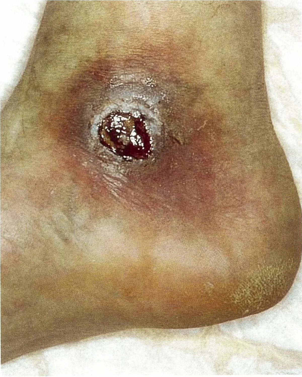 Venous stasis ulcer: a shallow ulcer with a red, granulating base above the medial ankle, surrounded by brown, hemosiderin-stained skin.