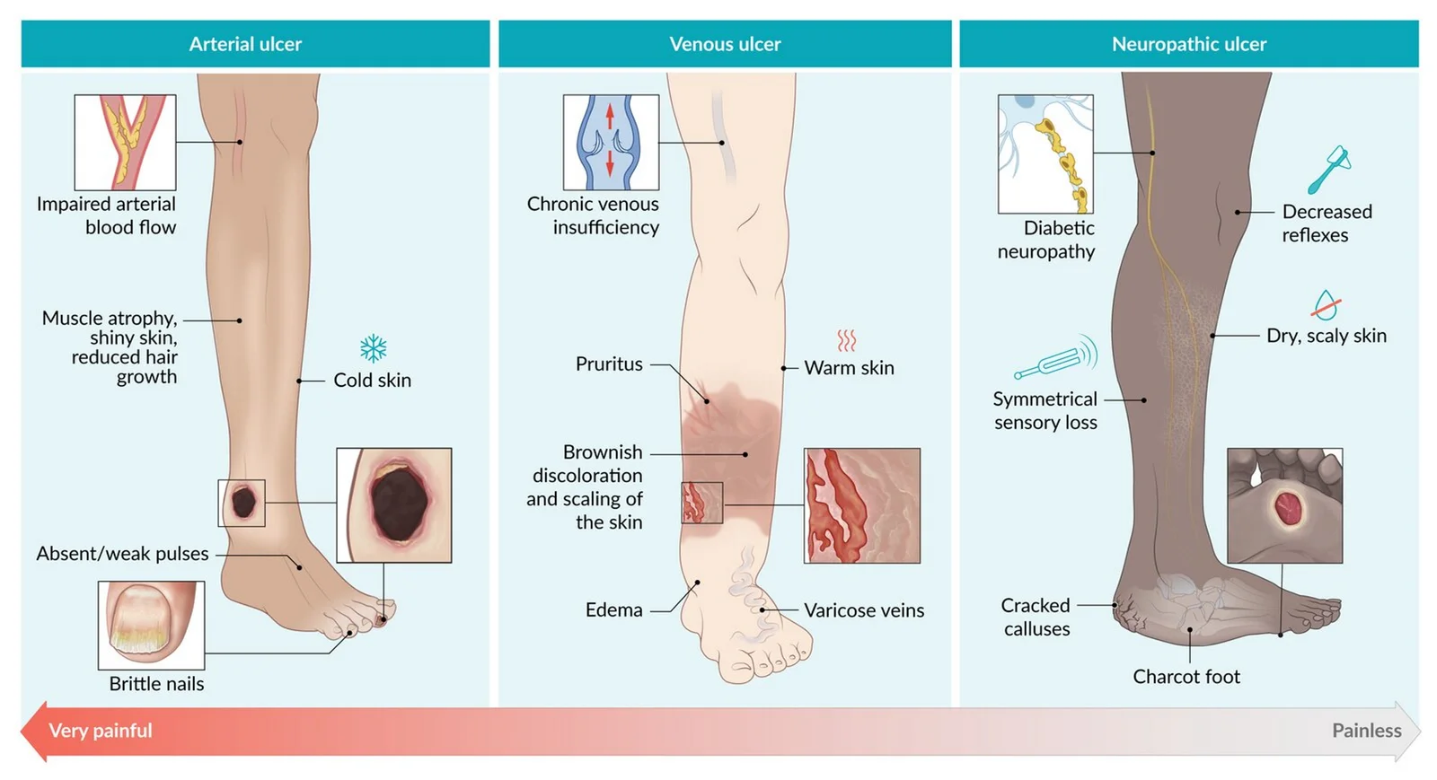 Leg ulcers compared: arterial (impaired arterial flow; cold, shiny, hairless skin, absent pulses; very painful), venous (chronic venous insufficiency; warm skin, edema, varicose veins, brown discoloration and scaling; mildly painful) and neuropathic (diabetic neuropathy; dry skin, cracked calluses, clawed toes, Charcot foot; painless).
