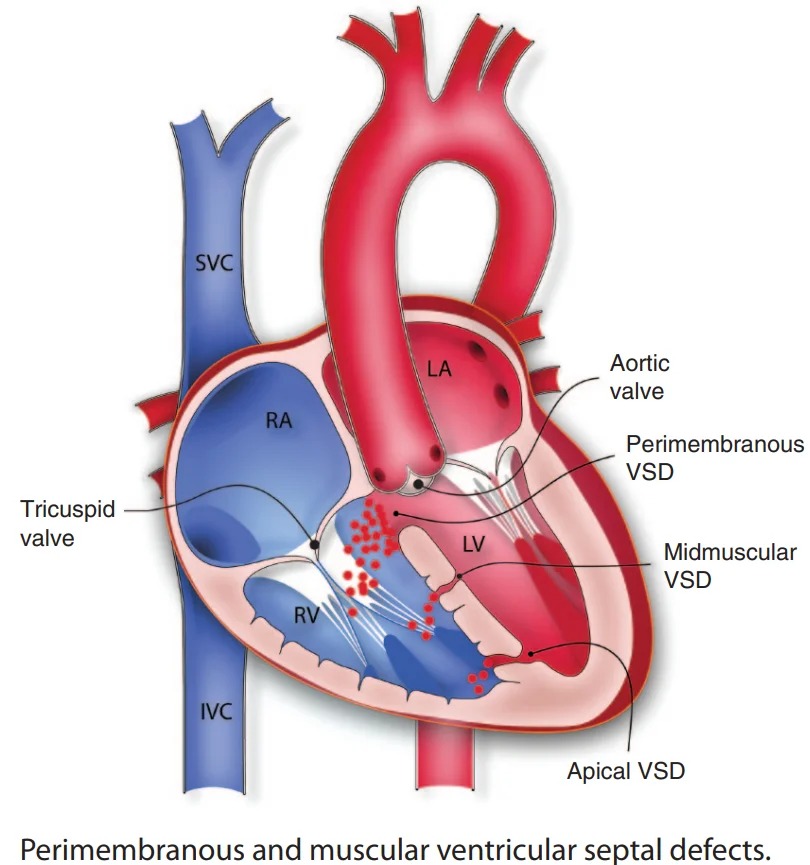 Ventricular septal defects by site: perimembranous (just below the aortic valve, the most common), midmuscular and apical; blood shunts from the left ventricle to the right.