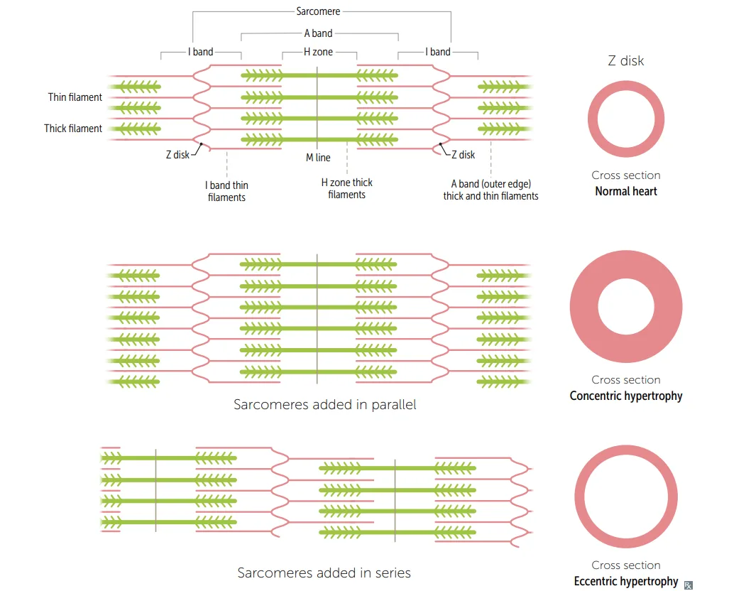 Sarcomere geometry and the ventricular cross-section it produces. Top: the normal sarcomere with Z disks, I band, A band and H zone, beside a normal ventricular wall. Middle: sarcomeres added in parallel thicken the wall inward, giving concentric hypertrophy (the pressure-overload pattern of hypertrophic cardiomyopathy and hypertension). Bottom: sarcomeres added in series lengthen the fibre, giving eccentric hypertrophy with a dilated chamber and thin wall (the volume-overload pattern of dilated cardiomyopathy).
