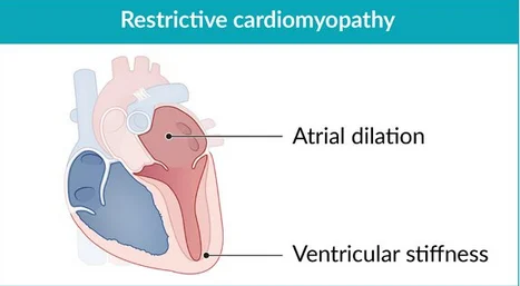 Restrictive cardiomyopathy: stiff ventricles of normal size that cannot fill, with both atria dilated from the high filling pressure.