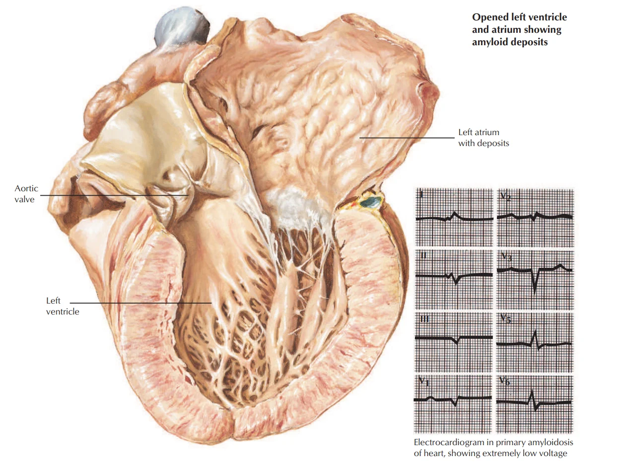 Amyloid cardiomyopathy: an opened heart with thickened, stiff walls and amyloid deposits in the left atrium, beside the ECG of primary amyloidosis showing extremely low voltage despite the thick walls.