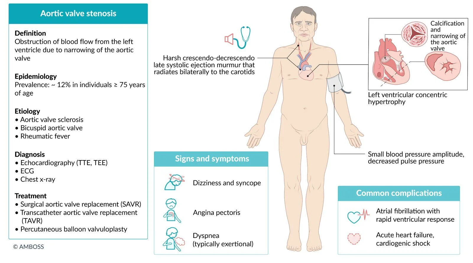 Aortic stenosis at a glance: a calcified, narrowed aortic valve with concentric left ventricular hypertrophy, a harsh late-peaking crescendo-decrescendo murmur radiating to both carotids, a narrow pulse pressure, and exertional syncope, angina and dyspnea. Atrial fibrillation or acute heart failure can tip the patient into decompensation.