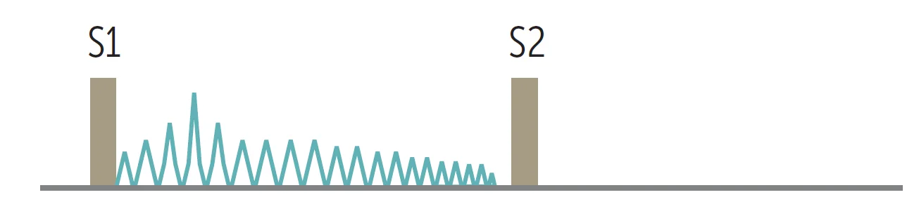 Aortic stenosis murmur: a crescendo-decrescendo (diamond-shaped) ejection murmur that starts after S1 and ends before S2. The later it peaks, the more severe the stenosis.