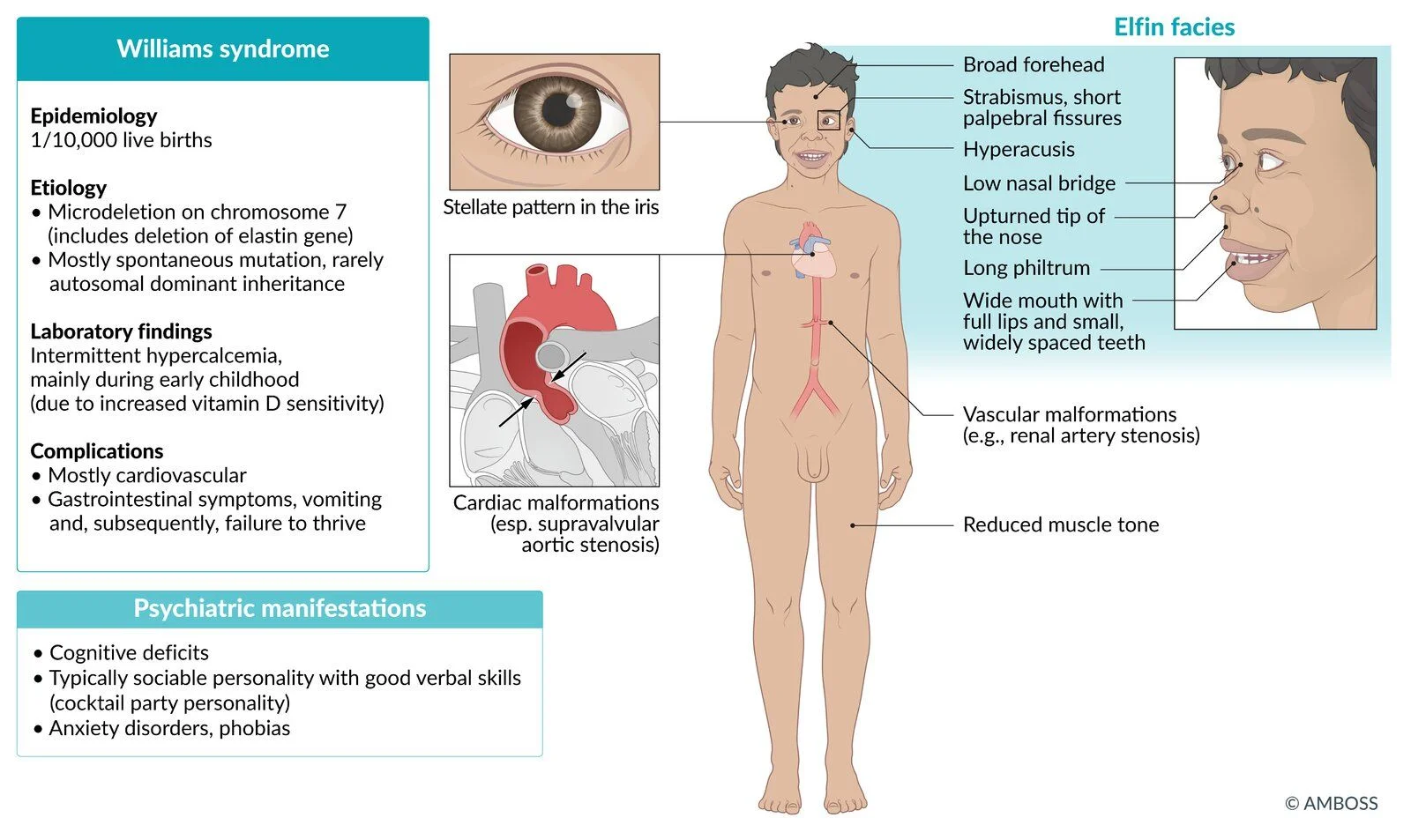 Williams syndrome: a chromosome 7 microdeletion that includes the elastin gene. Elfin facies (broad forehead, upturned nose, long philtrum, wide mouth with small, widely spaced teeth), a stellate iris, a very sociable personality with cognitive deficits, childhood hypercalcemia, and supravalvular aortic stenosis with other arterial narrowings such as renal artery stenosis.
