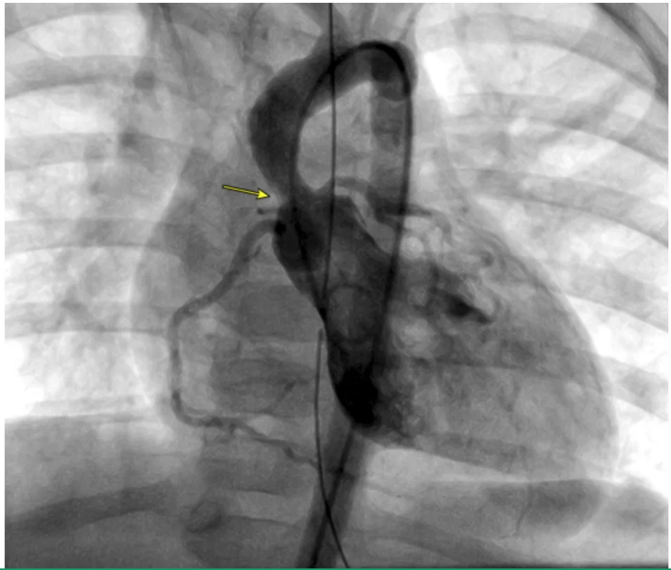 Supravalvular aortic stenosis on an angiogram: a discrete waist in the ascending aorta just above the valve (arrow) in a patient with Williams syndrome.