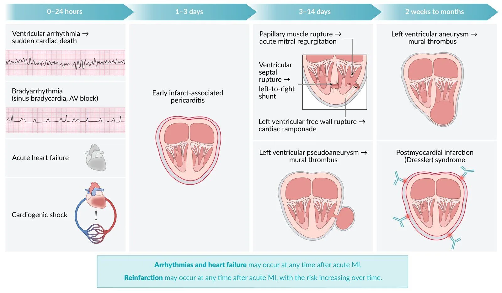 Complications of MI on a timeline. 0 to 24 hours: ventricular arrhythmia and sudden death, bradyarrhythmia and AV block, acute heart failure, cardiogenic shock. 1 to 3 days: early infarct-associated pericarditis. 3 to 14 days: papillary muscle rupture with acute mitral regurgitation, ventricular septal rupture with a left-to-right shunt, free wall rupture with tamponade, pseudoaneurysm with mural thrombus. 2 weeks to months: true left ventricular aneurysm with mural thrombus, and Dressler syndrome. Arrhythmias, heart failure and reinfarction can occur at any time.