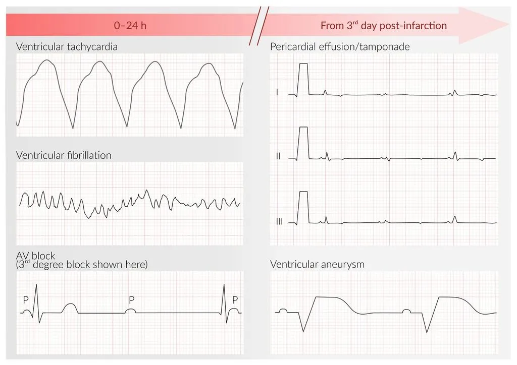 Tracings along the post-MI clock. First 24 hours: ventricular tachycardia, ventricular fibrillation and AV block (third-degree block shown). From the third day: pericardial effusion or tamponade (low voltage) and, later, the persistent ST elevation of a ventricular aneurysm.