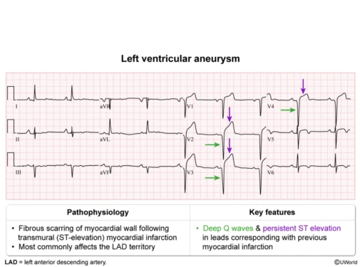 Left ventricular aneurysm: deep Q waves with persistent ST elevation in the leads of the prior transmural (usually anterior, left anterior descending) infarct, from fibrous scarring of the wall.
