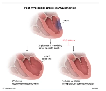 Post-MI ACE inhibition: angiotensin II drives remodeling over weeks to months, with infarct ballooning, left ventricular dilation and reduced function; an ACE inhibitor limits infarct expansion and preserves contractile function.
