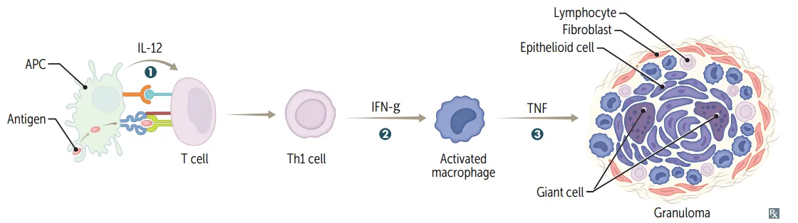 Granuloma formation: activated macrophages (driven by Th1 IFN-gamma and TNF) become epithelioid cells and multinucleated giant cells that wall off the stimulus.