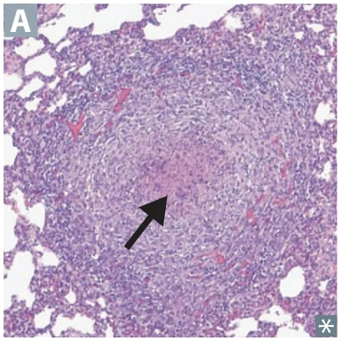 Granuloma: epithelioid macrophages surrounded by lymphocytes.