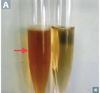 Paroxysmal nocturnal hemoglobinuria: dark tea-colored urine (hemoglobinuria, arrow) vs normal; complement-mediated RBC lysis from loss of GPI-anchored DAF (CD55)/CD59.