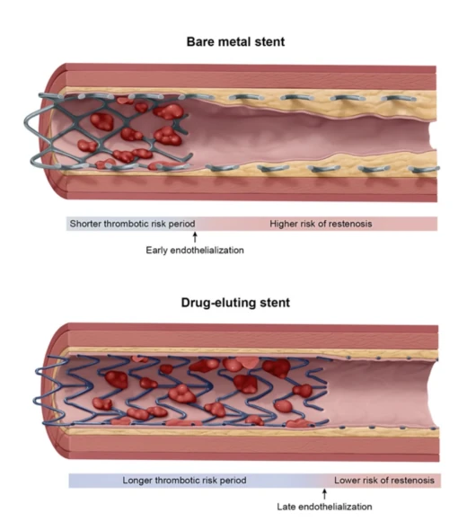 Bare-metal versus drug-eluting stent: the bare-metal stent endothelializes early (shorter thrombotic risk period, higher risk of restenosis); the drug-eluting stent endothelializes late (longer thrombotic risk period, lower risk of restenosis). Drug-eluting stents reduce neointimal restenosis but make uninterrupted antiplatelet planning essential.