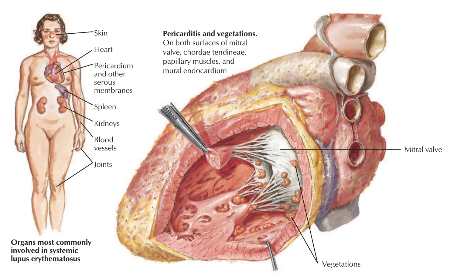 Libman-Sacks endocarditis in systemic lupus erythematosus: small verrucous vegetations on both surfaces of the mitral valve and on the chordae, papillary muscles and mural endocardium. Beside it are the organs lupus most often involves: skin, heart and pericardium, spleen, kidneys, blood vessels and joints.