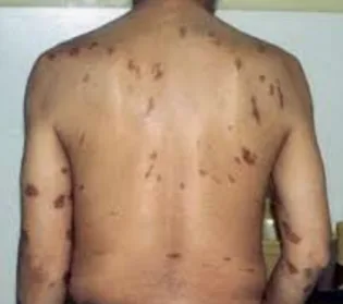 Kaposi sarcoma: many violaceous to brown patches and plaques scattered over the back, following the skin lines.