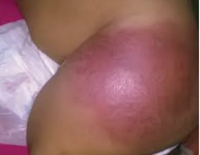 Infantile hemangioma: a raised, red to purple vascular plaque in an infant; benign.