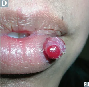 Pyogenic granuloma: a bright red, glistening, friable nodule on the lip that bleeds easily.