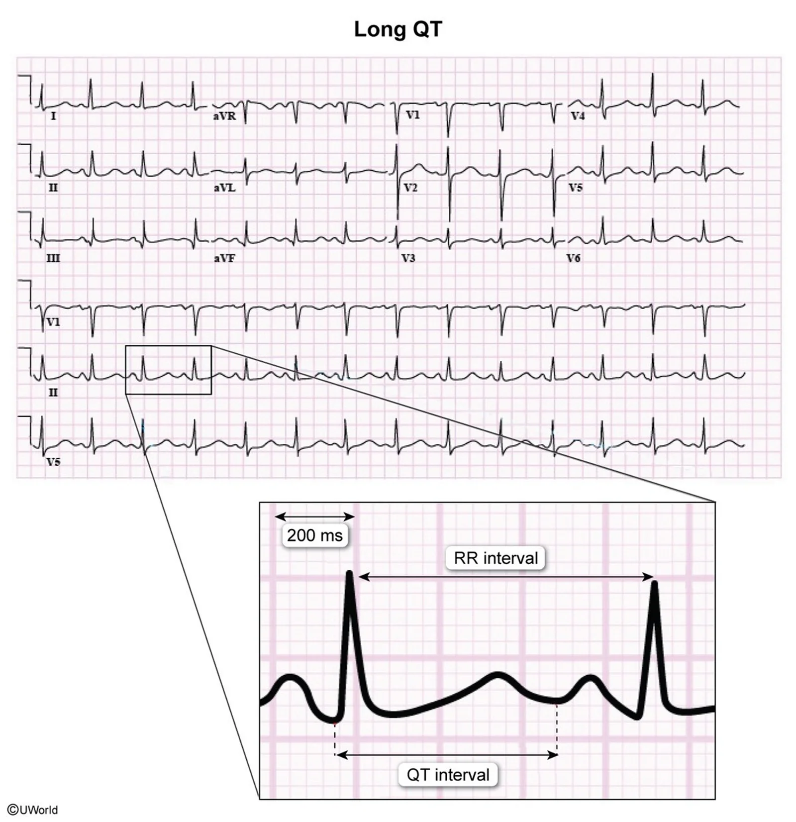Long QT on a 12-lead electrocardiogram (ECG), with the measurement enlarged: the QT interval runs from the start of the QRS to the end of the T wave, and here it is longer than half the R-R interval.