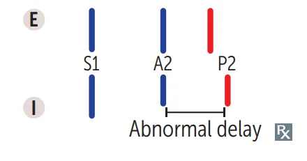 Wide splitting: P2 is already late on expiration and later still on inspiration, an abnormal delay (pulmonic stenosis, right bundle branch block).