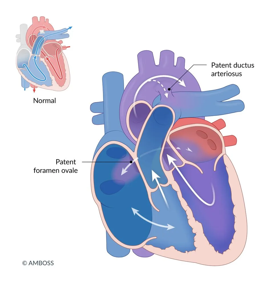 Ebstein anomaly: the tricuspid leaflets sit low in the right ventricle, so part of the ventricle becomes atrium (atrialization), the right atrium is huge, and blood leaks back through the valve (the two-way arrow). In the newborn, a patent foramen ovale and ductus arteriosus carry the circulation.