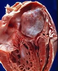 Gross specimen of an atrial myxoma: a smooth, rounded, gelatinous mass filling the opened atrium.