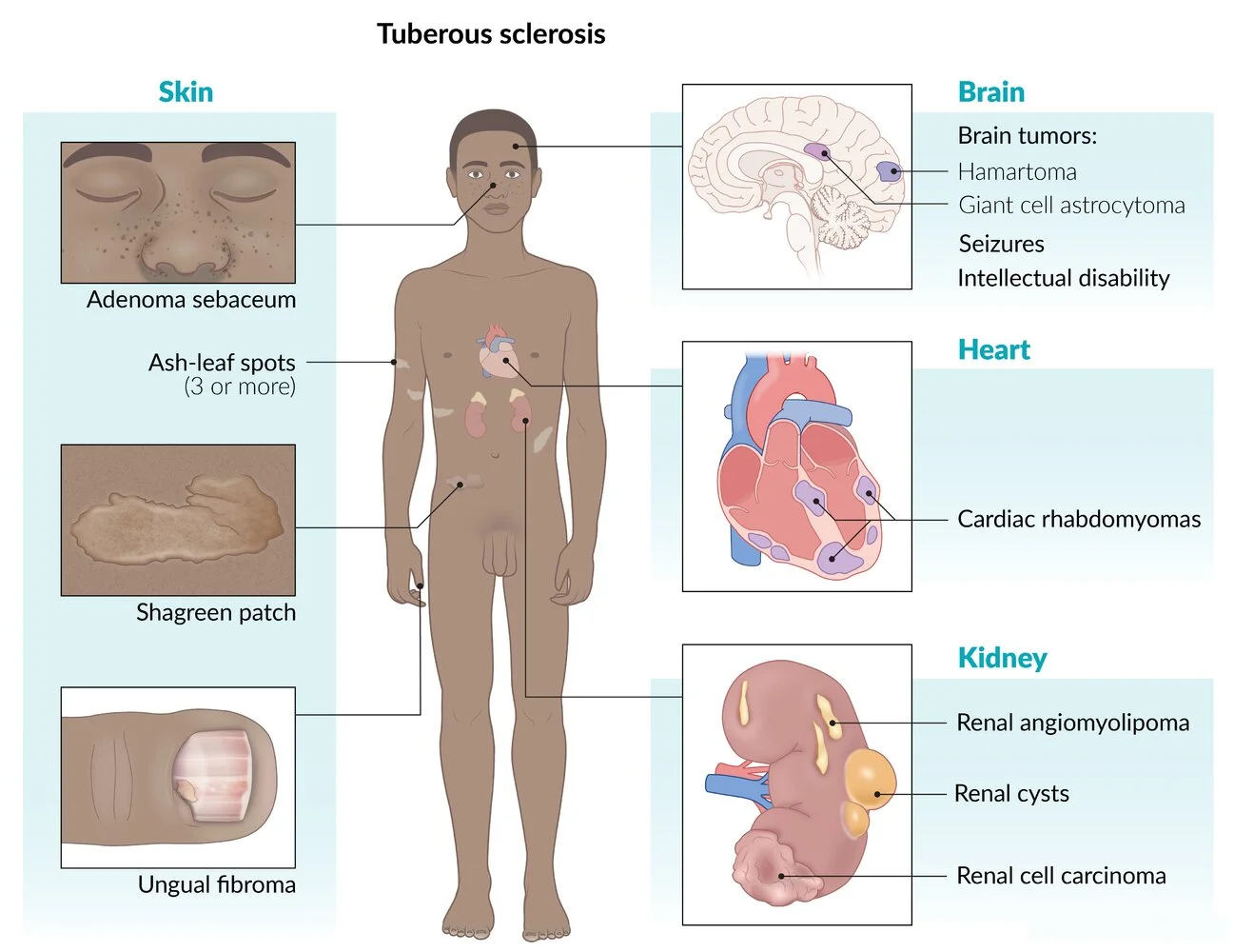 Tuberous sclerosis: cardiac rhabdomyomas in the ventricles; brain hamartomas and giant cell astrocytoma with seizures and intellectual disability; skin signs (adenoma sebaceum, 3 or more ash-leaf spots, shagreen patch, ungual fibroma); and kidney angiomyolipomas, cysts and renal cell carcinoma.