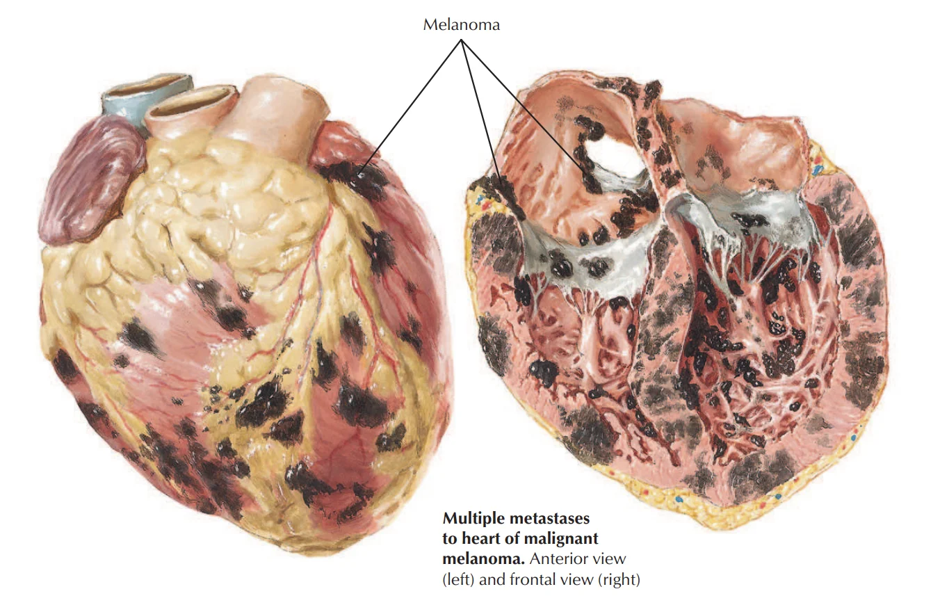 Metastatic melanoma to the heart, from the front and in cross-section: multiple black deposits scattered over the surface and through the myocardium of both ventricles.