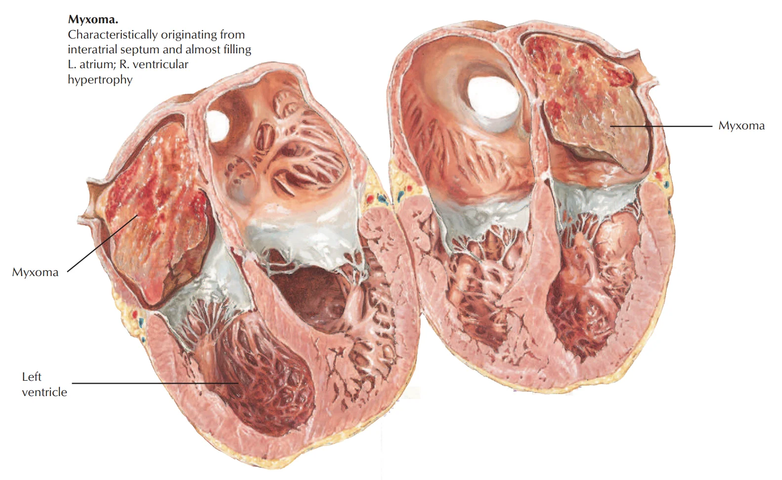 Atrial myxoma: a mass arising from the interatrial septum and almost filling the left atrium, where it blocks mitral inflow like mitral stenosis; the right ventricle hypertrophies against the raised pressure.