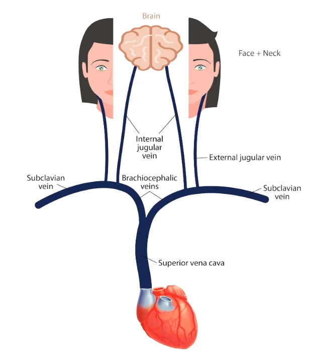 Venous drainage of the head, neck and upper limbs. The brain drains through the internal jugular vein, while the face and superficial neck drain through the external jugular vein into the subclavian vein. On each side the internal jugular and subclavian veins unite as a brachiocephalic vein, and the two brachiocephalic veins join to form the superior vena cava entering the right atrium. Reading the diagram explains the clinical split: obstruction of the SVC swells both sides of the head, neck and both arms, whereas obstruction of one brachiocephalic vein swells only that side.