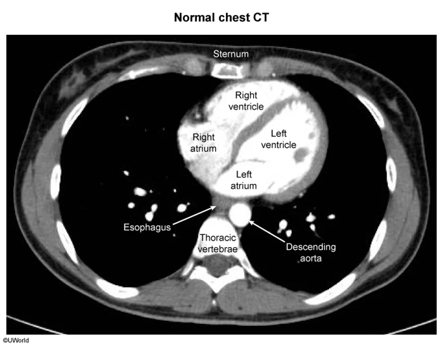 Normal axial chest CT, which settles the chamber-position question in one image. The right ventricle lies immediately behind the sternum, which is why it is the chamber injured by a stab wound to the anterior chest. The left atrium is the most posterior chamber, and directly behind it lie the esophagus, the thoracic vertebra and the descending aorta, which is the whole anatomic explanation for the dysphagia and hoarseness of left atrial enlargement and for what a transesophageal probe can see in each direction.