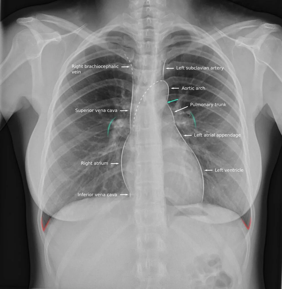 Normal chest radiograph with the cardiac borders and great vessels labelled. Down the right side lie the right brachiocephalic vein, the superior vena cava, the right atrium forming the right heart border, and the inferior vena cava at the diaphragm. Down the left side lie the left subclavian artery, the aortic arch (the aortic knob), the pulmonary trunk, the left atrial appendage and the left ventricle forming the left heart border. Knowing which structure makes which contour is what lets a widened or straightened border on a plain film be attributed to a specific chamber or vessel.