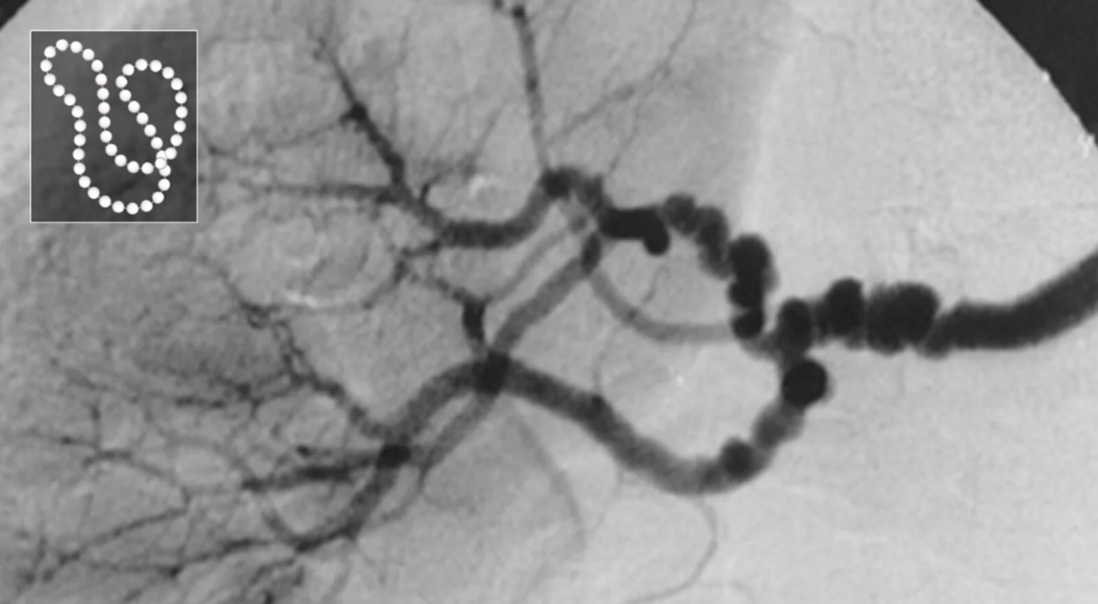 String of beads in fibromuscular dysplasia on renal angiography: alternating narrowings and small aneurysmal dilations along the mid-to-distal renal artery, like a string of pearls (inset).