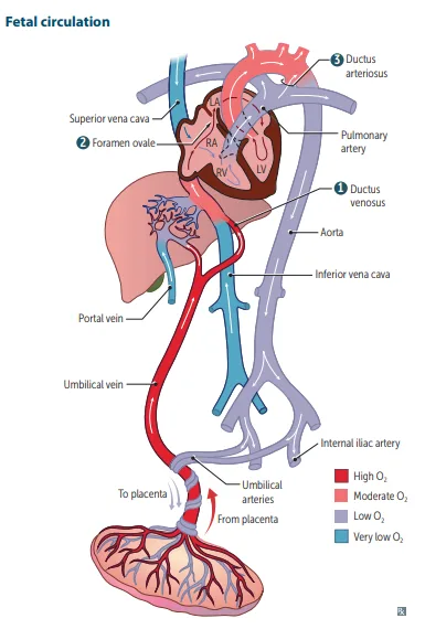 Fetal circulation, colour-coded by oxygen content. Oxygenated blood returns from the placenta in the umbilical vein and (1) bypasses the liver through the ductus venosus into the IVC; (2) most of it crosses the foramen ovale from RA to LA, bypassing the lungs; (3) deoxygenated SVC blood that reaches the pulmonary artery is diverted through the ductus arteriosus into the descending aorta. Blood returns to the placenta via the internal iliac and umbilical arteries.