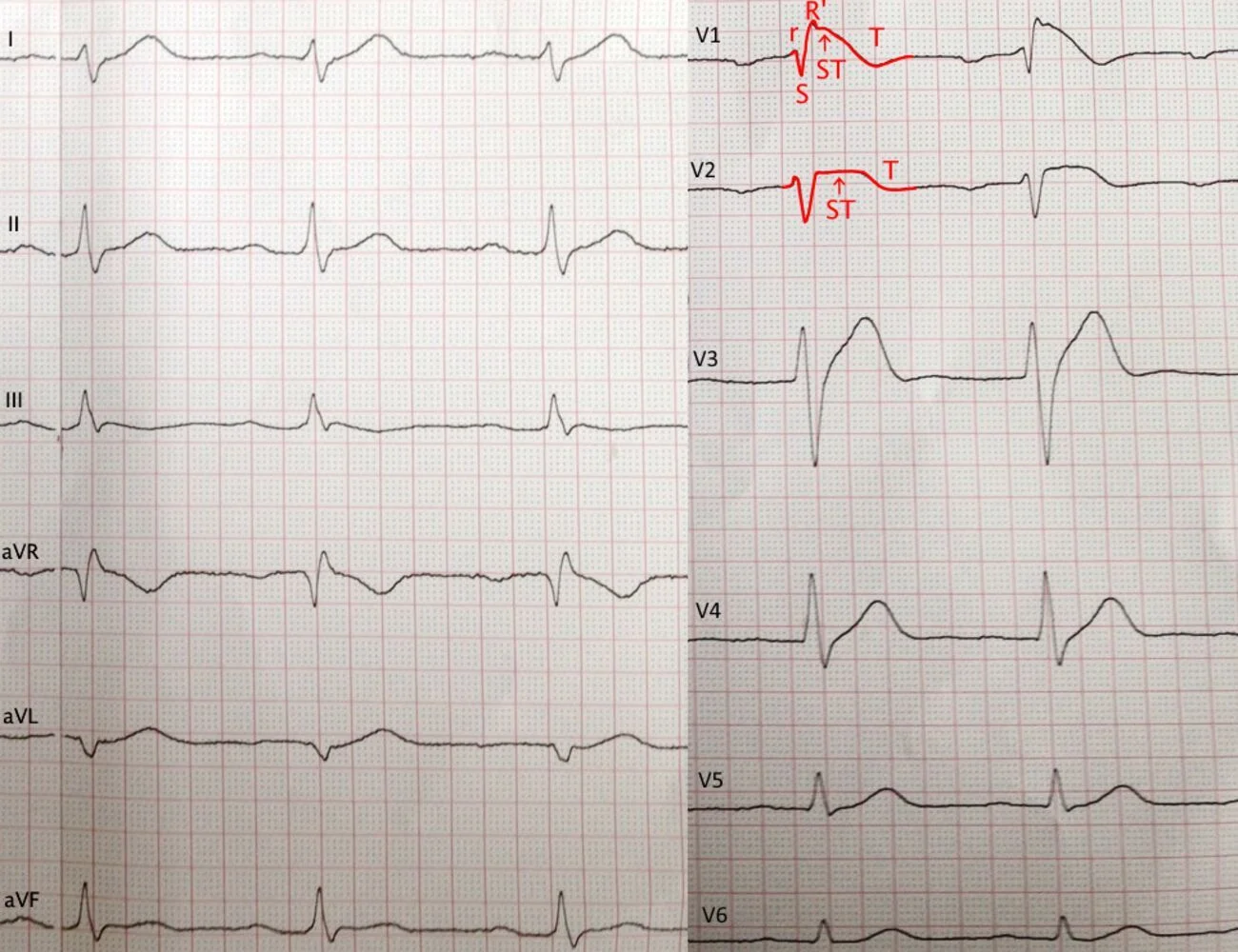 Brugada pattern: in V1 an rSR' shape like right bundle branch block, with ST elevation that slopes down into an inverted T wave (coved); V2 shows raised ST as well, and the other leads are unremarkable.
