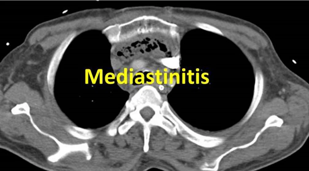 Post-operative mediastinitis on chest CT: fluid and soft-tissue stranding fill the anterior mediastinum behind the sternum.
