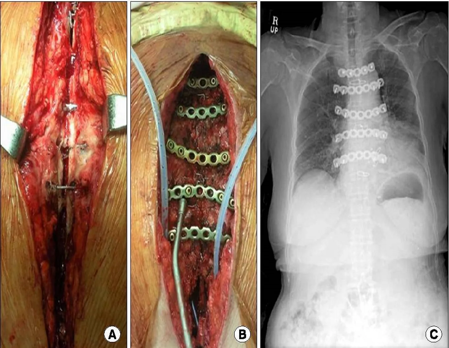 Sternal closure after dehiscence: the open, separated sternum (A), re-fixation with plates across the sternal halves (B), and the plates seen on the chest radiograph afterwards (C).