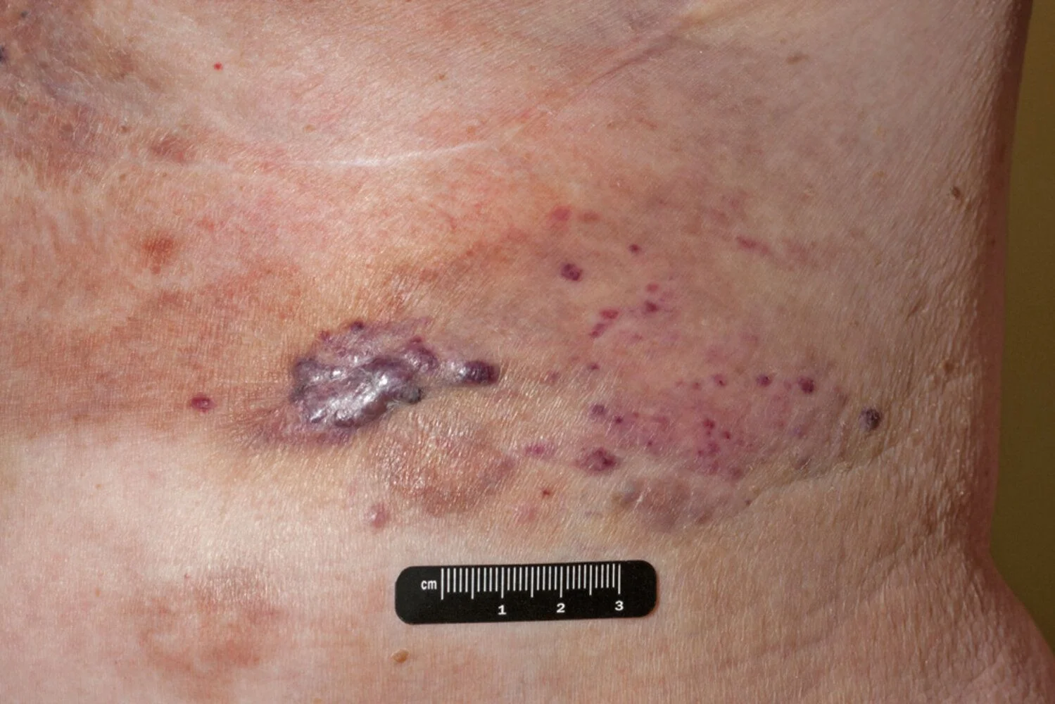 Cutaneous angiosarcoma: a violaceous, bruise-like plaque with scattered purple satellite papules on sun-damaged skin of an older patient.