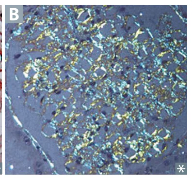 Amyloidosis: apple-green birefringence of Congo red-stained amyloid under polarized light.