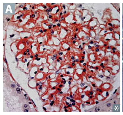 Amyloidosis: Congo red stain (amyloid appears red on light microscopy).