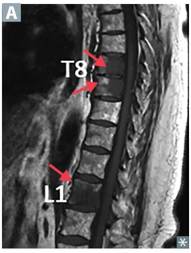 Vertebral (bone) metastases on MRI (T8, L1; arrows).