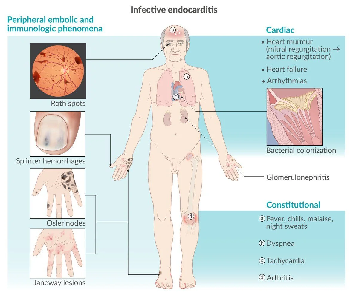 Infective endocarditis at a glance: bacteria colonize the valve and cause a regurgitant murmur (mitral, then aortic), heart failure and arrhythmias. Emboli and immune complexes give Roth spots, splinter hemorrhages, Osler nodes (painful, on the finger pads), Janeway lesions (painless, on the palms and soles) and glomerulonephritis. Constitutional signs are fever, chills, night sweats, dyspnea, tachycardia and arthritis.