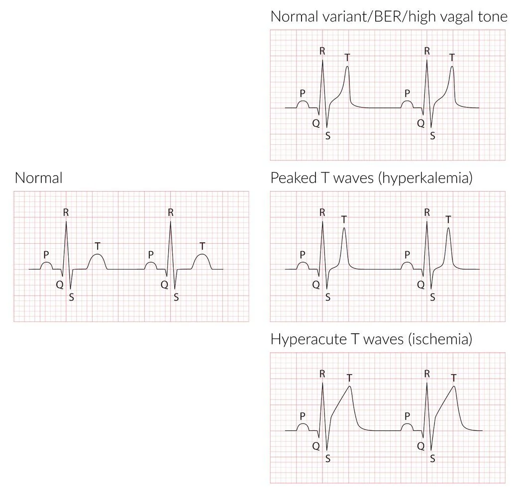 T-wave shapes compared with a normal complex: a normal variant with high vagal tone, narrow symmetrical peaked T waves of hyperkalemia, and broad tall hyperacute T waves of early ischemia.