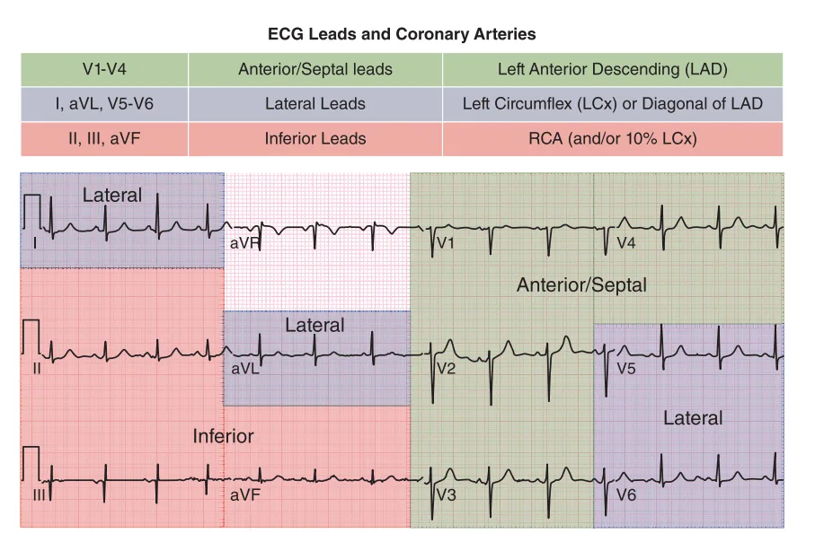 Infarct territory by leads on a 12-lead ECG: V1 to V4 anterior and septal (left anterior descending artery), I, aVL, V5 and V6 lateral (left circumflex or a diagonal branch), II, III and aVF inferior (right coronary artery, or the circumflex in about 10%).